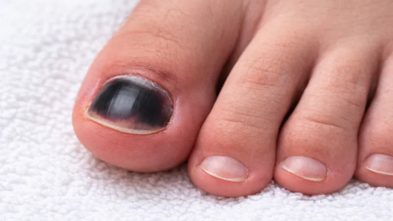 Ongle de pied noirci du gros orteil avec coloration violacée typique d’un hématome sous-unguéal après un choc